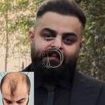 کلینیک کاشت مو باراد تهران