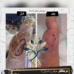 درمان زخم در منزل