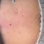 فیشال و پاکسازی پوست لونا در همدان