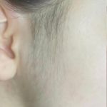 خدمات الکترولیز موهای زائد شاینا