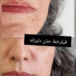 کلینیک هانیل | فیلر و بوتاکس شرق