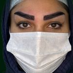 کاشت ابرو شادی حسینی