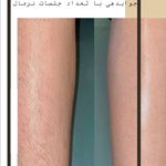 مرکز لیزر مو های زائد کندلا دکتر حجازی