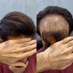 پروتز مو طبیعی  صادقی