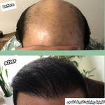 کلینیک تخصصی کاشت موی پرنیان