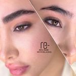 میکروبلیدینگ رویا