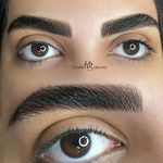 میکروبلیدینگ و فیبروز المیرا