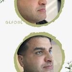 کلینیک لیزر  کندلاوزیبایی پوست ومو آیشیل
