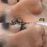 پلاسمای صورت  و چربی سوزی بینی