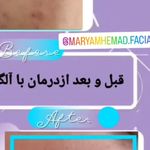 فیشیال و پاکسازی پوست مریم