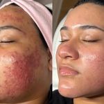 فیشال و پاکسازی پوست درنواب