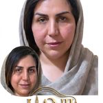 کلینیک هانیل | فیلر و بوتاکس شرق