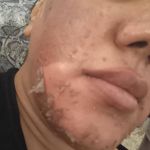 پاکسازی پوست میرزایی