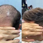 پروتز مو طبیعی  صادقی