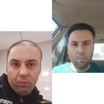 کاشت مو سحر کارگر