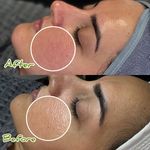 فیشال تخصصی و درمان جوش ولک Zhikan