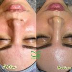 فیشال تخصصی و درمان جوش ولک Zhikan