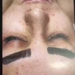 فیشال تخصصی و درمان جوش ولک Zhikan