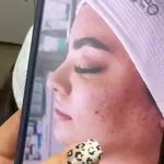 فیشال تخصصی و درمان جوش ولک Zhikan