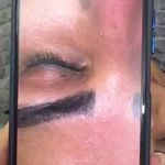 فیشال تخصصی و درمان جوش ولک Zhikan