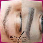 ریموو علمی تتو با اصول پزشکی مارال