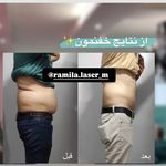 مرکز لیزر موهای زائد رمیلا