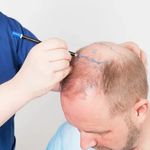 کاشت مو و ابرو دکتر یوسفی