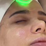 فیشیال و پاکسازی تخصصی پوست مرضیه