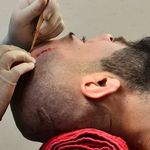 کلینیک تخصصی کاشت ابرو و مو صدف