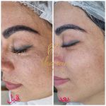 فیشال و پاکسازی پوست درنواب