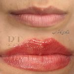 مرکز میکروبلیدینگ شیدینگ ریموو اسکالپ