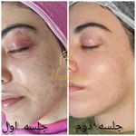فیشال و پاکسازی پوست درنواب