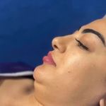 لیزر و ژل و بوتاکس پریناز