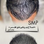 موسسه آموزش و درمان انواع ریزش مو ریشه