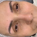 ریموو شیدینگ میکروبلیدینگ