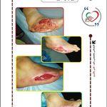 تیم تخصصی درمان زخم خانه سلامت