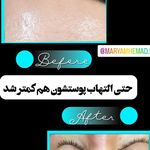 فیشیال و پاکسازی پوست مریم