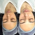 فشیال و پاکسازی پوست النازوید