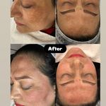 پاکسازی پوست به صورت حرفه ای و تخصصی – خانم سارا حزباویان