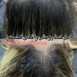 موسسه آموزش و درمان انواع ریزش مو ریشه