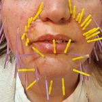 مطب طب سوزنی و حجامت دکتر سیفی