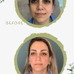 کلینیک لیزر  کندلاوزیبایی پوست ومو آیشیل