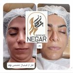 فیشیال و پاکسازی نگار