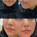 کلینیک ژل بوتاکس لیزر فیل بیوتی