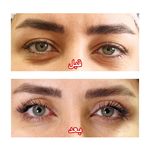 بلفاروپلاستی دکتر سیدمحمدرضا حسینی