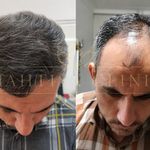 کلینیک کاشت مو ماهتیسا