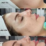 مرکز تخصصی فیشال و پاکسازی پوست تینا