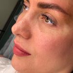 میکروبلیدینگ عسل علیزاده