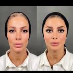 خدمات تخصصی ژل بوتاکس لیزر فیل بیوتی