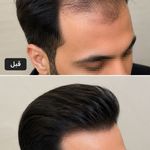 کاشت مو ابان